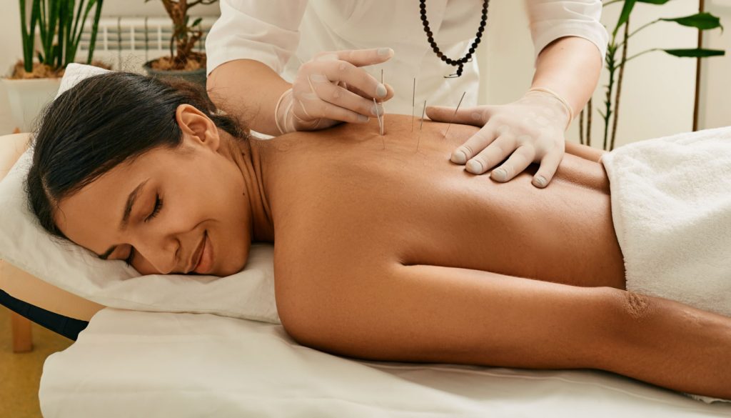 Acupuncture needles being placed on a patient's back